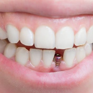 Smile with dental implant