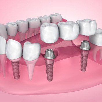Exploded illustration of dental bridge and dental implants