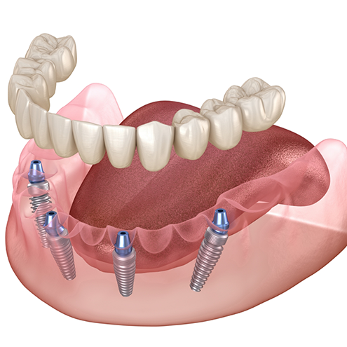 Illustrated All on X denture being placed onto four dental implants