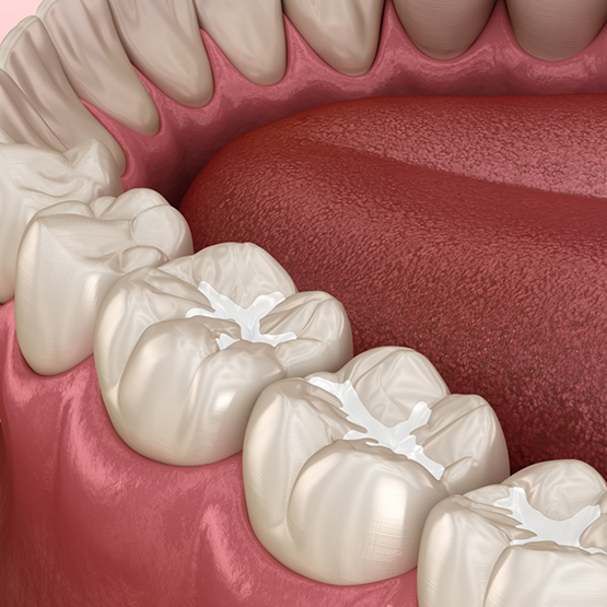 Illustrated row of teeth with white filling material