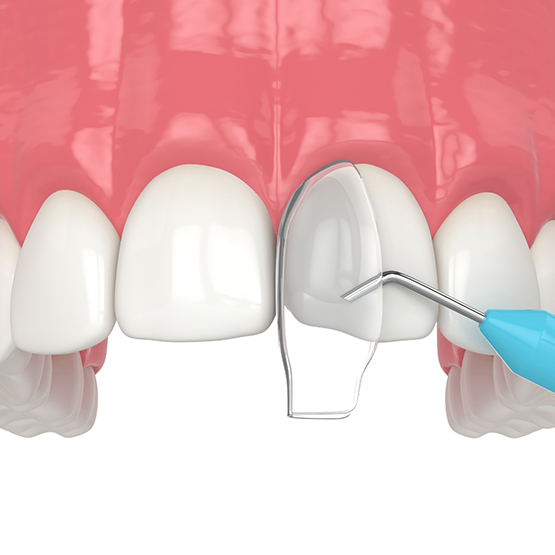 Illustration of dental bonding material being applied to upper front tooth