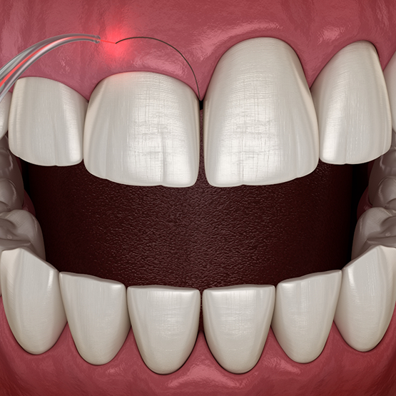 Illustrated dental laser treating an uneven gumline