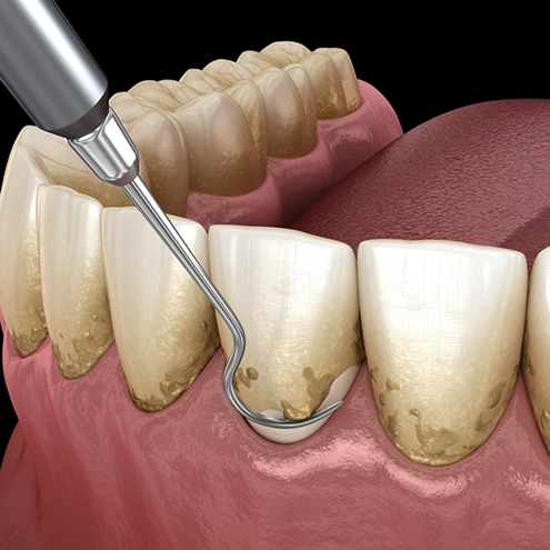 Illustrated dental scaler clearing plaque from teeth during gum disease treatment