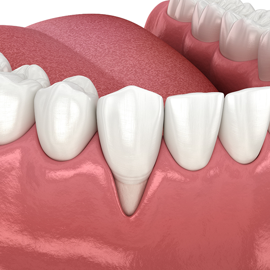 Illustrated mouth with receding gums