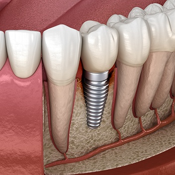 Illustration of single dental implant