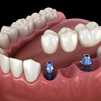 Illustration of implant bridge