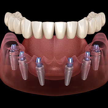 Illustration of implant denture