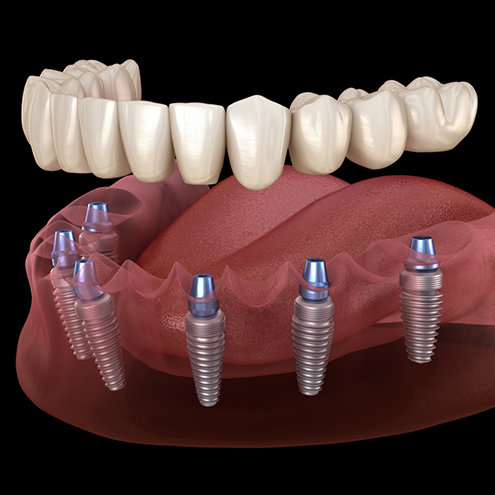 Illustrated full implant denture in Reno on lower arch