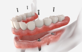 Illustrated model of an implant denture