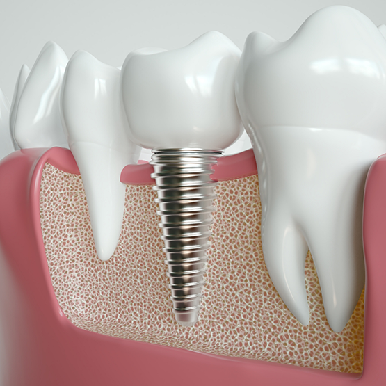 Illustrated dental implant replacing a missing tooth