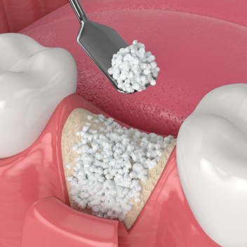 Illustration of bone grafting material being placed into socket after tooth extraction