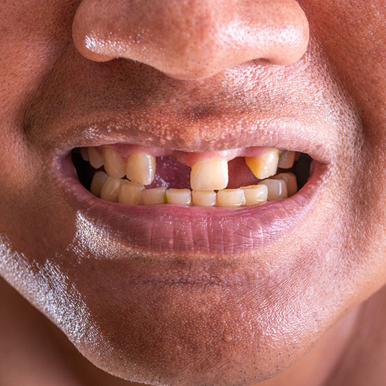 Close up of man smiling with several missing teeth