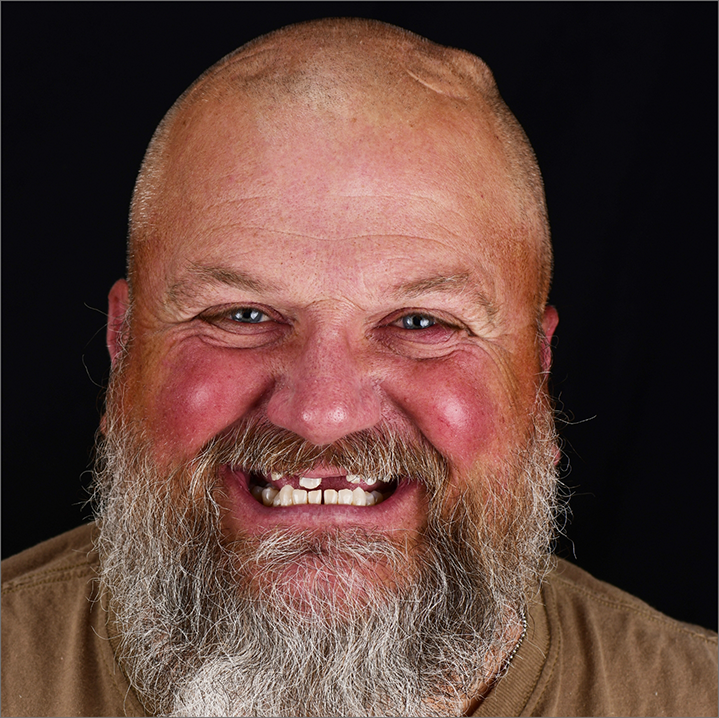 Bearded man smiling with several missing teeth