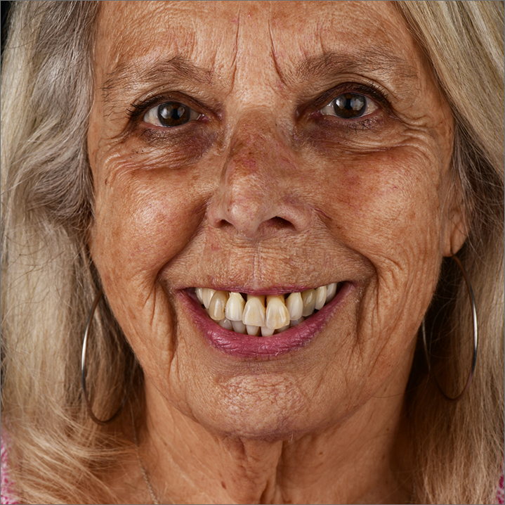 Senior woman smiling with long discolored teeth