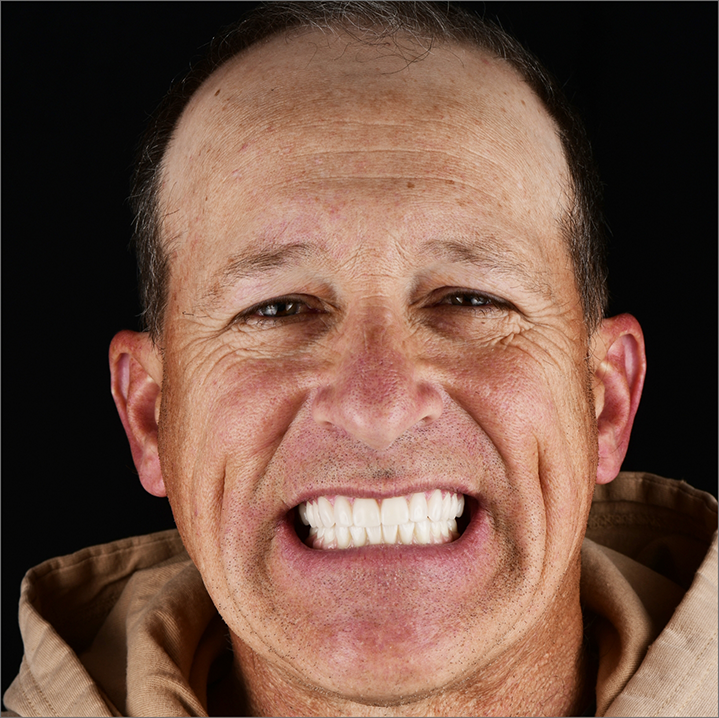 Older man smiling with whiter teeth