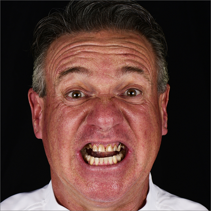 Senior man with yellowed teeth