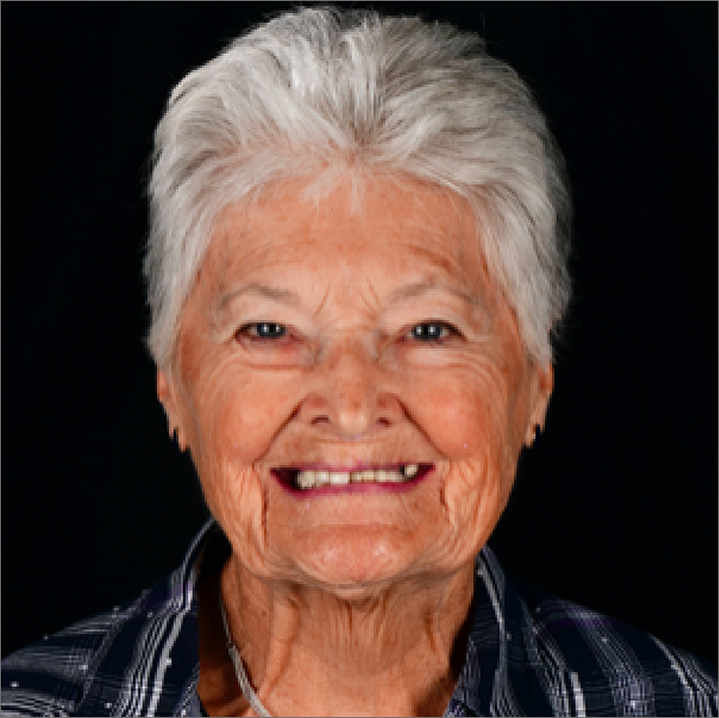 Senior woman grinning with heavily damaged teeth