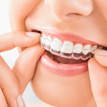 Close up of person placing clear aligner over their teeth