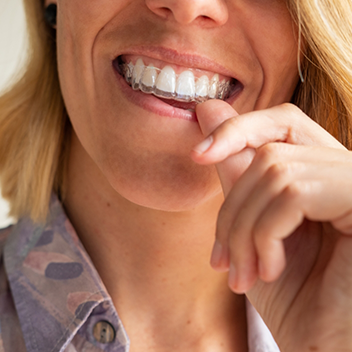 Woman placing a clear aligner over her teeth