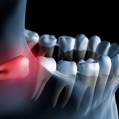 Illustration of impacted wisdom tooth pressing against adjacent tooth