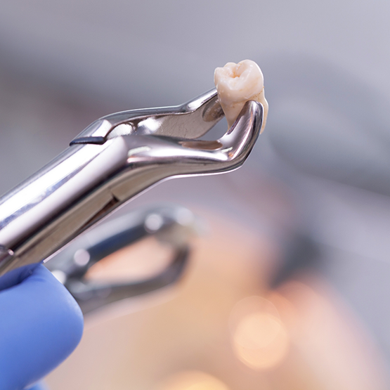 Dental clasp holding an extracted tooth