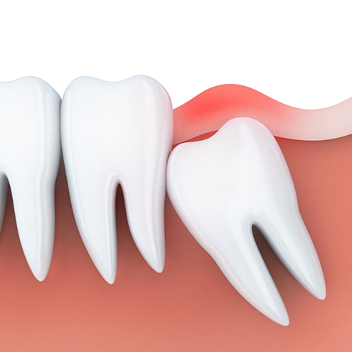 Illustrated impacted wisdom tooth pressing against adjacent molar