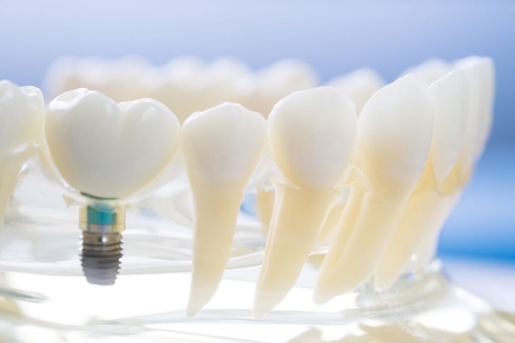 A model of dental implants in a jaw